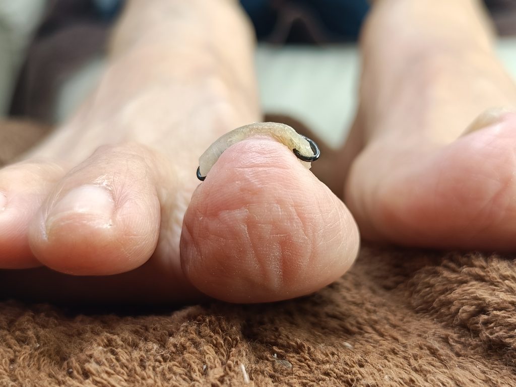清和からお越しのS様（82歳女性）
巻き爪施術3回目右足正面からのビフォーアフター写真