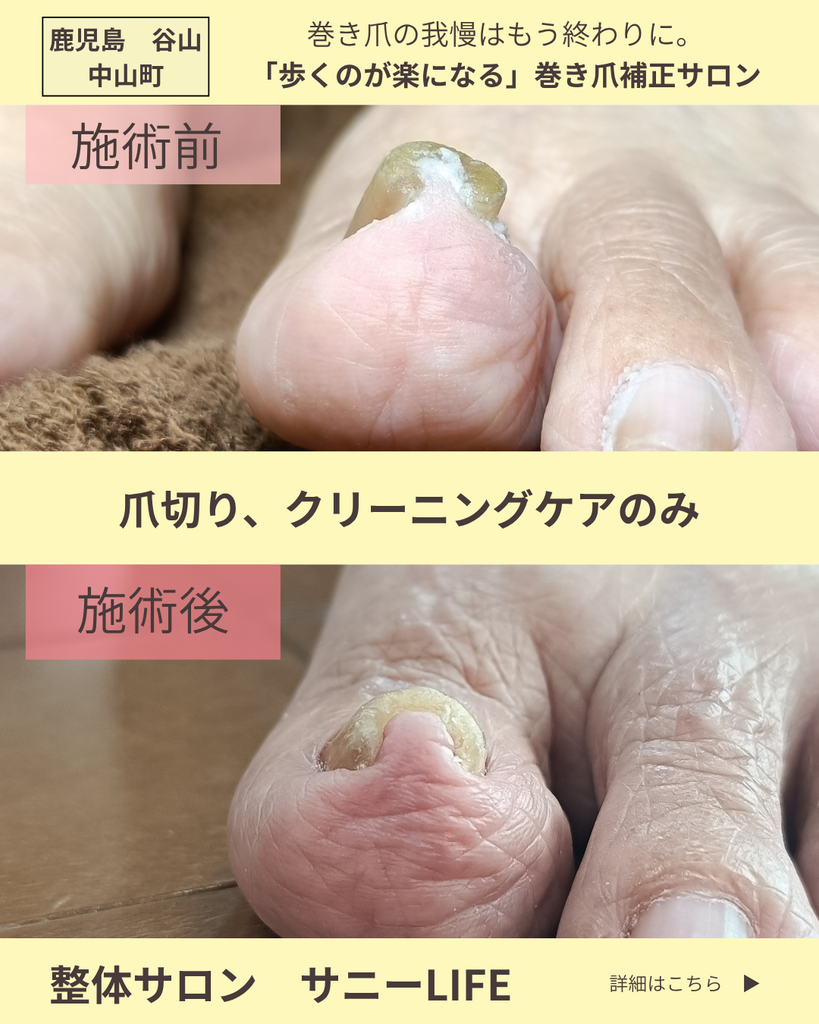 清和からお越しのS様（82歳女性）
左足巻き爪
施術前と2回目施術後の正面からのビフォーアフター写真