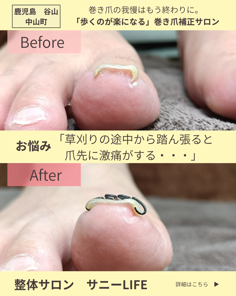 上福元町からお越しのT様（６２歳男性）
巻爪の1回目の施術後の写真右足