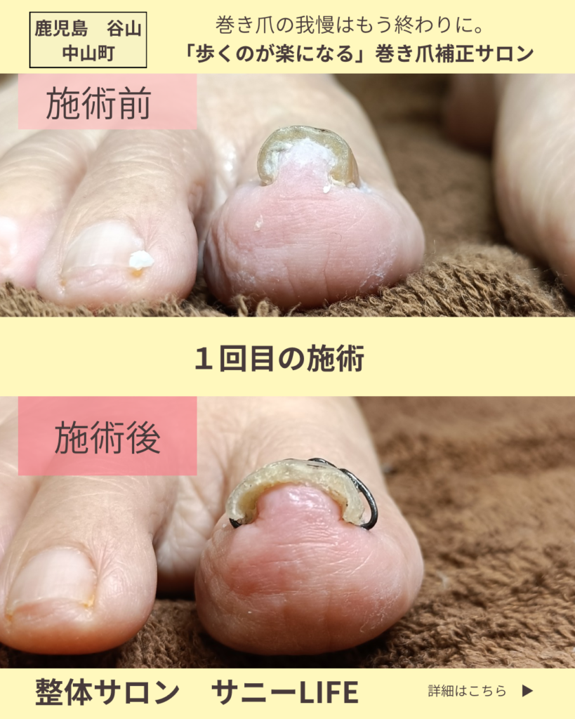 清和からお越しのS様（82歳女性）
巻き爪施術１回目右足のビフォーアフター写真