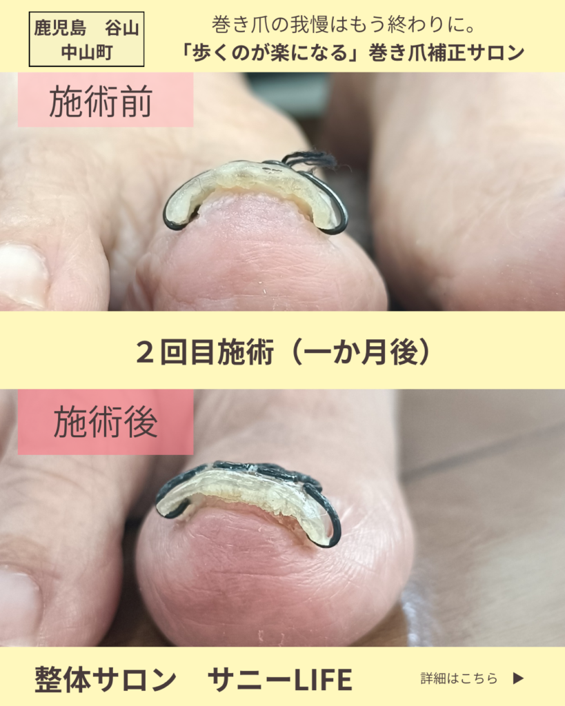清和からお越しのS様（82歳女性）
巻き爪施術2回目右足のビフォーアフター写真