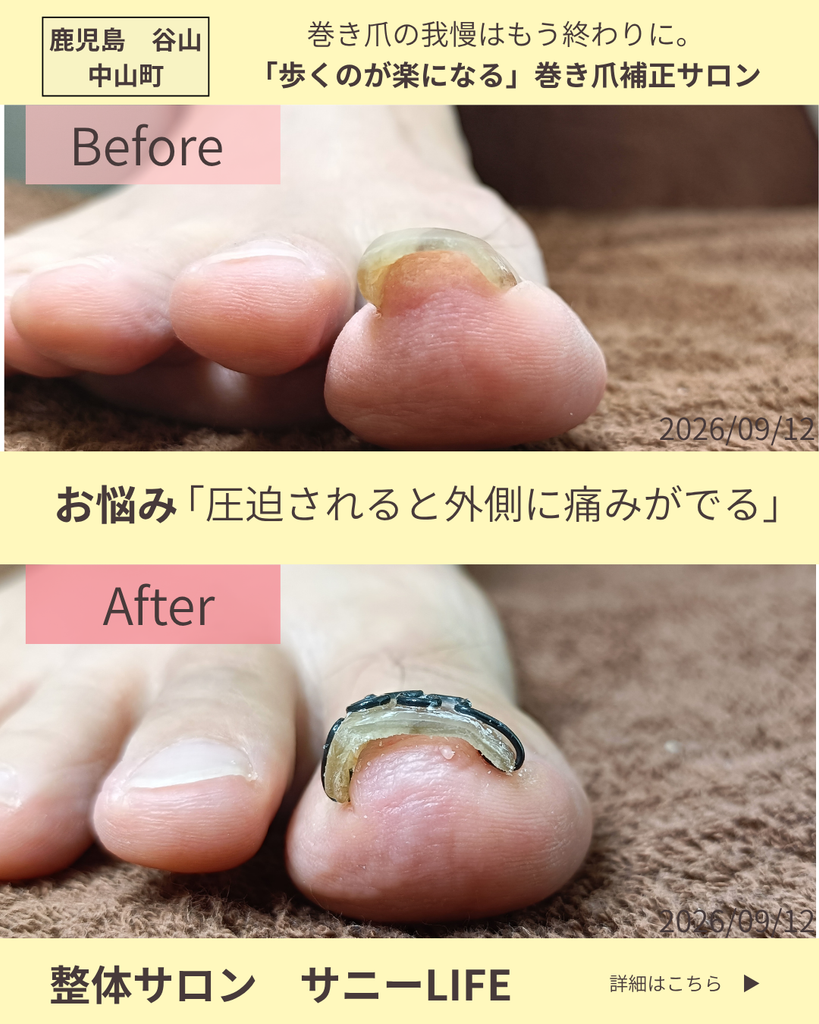 中山町からお越しのO様（73歳女性） 巻爪の1回目の施術のビフォーアフター写真 右足正面から