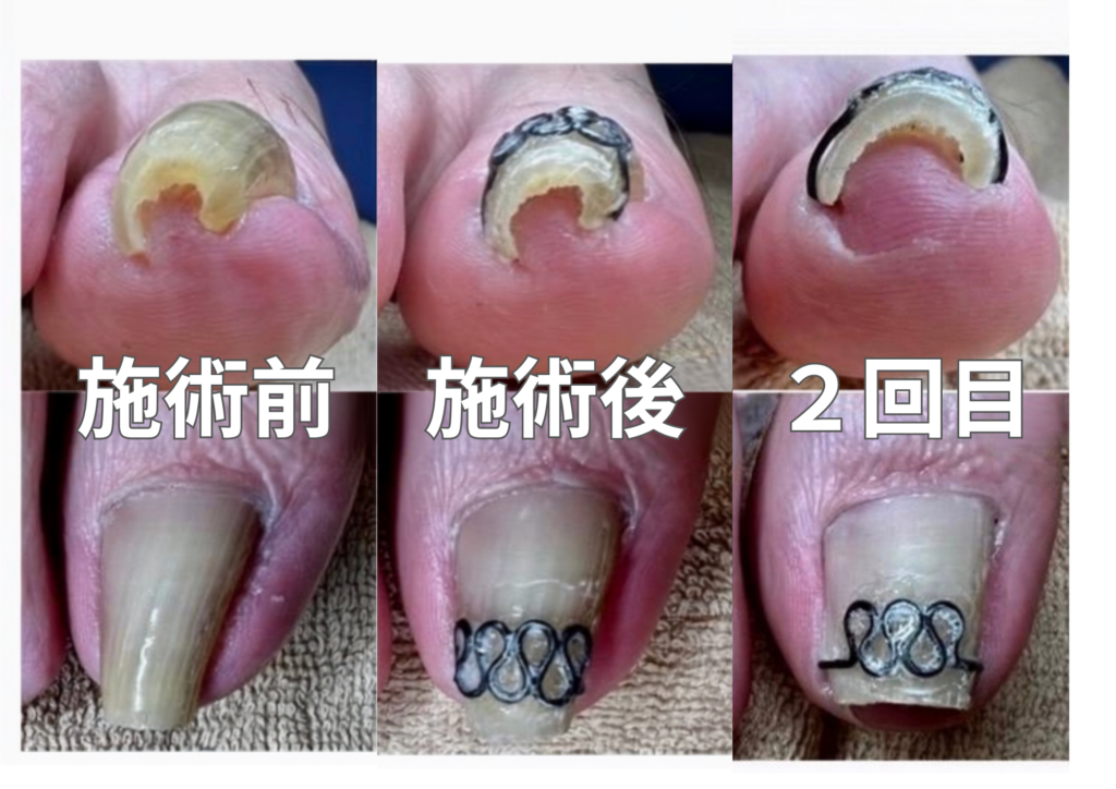 巻き爪の施術前
巻き爪の施術後
2回目の施術後の写真
